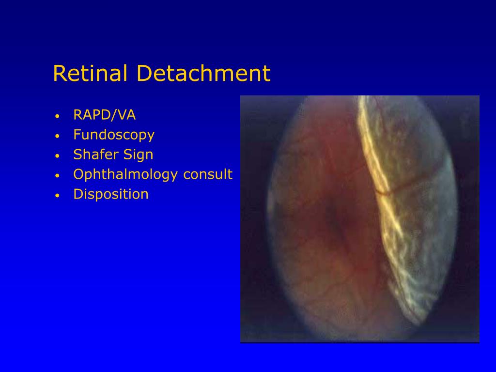 PPT Orbital Trauma PowerPoint Presentation Free Download ID 6737616 PPT Orbital Trauma PowerPoint Presentation Free Download ID 6737616