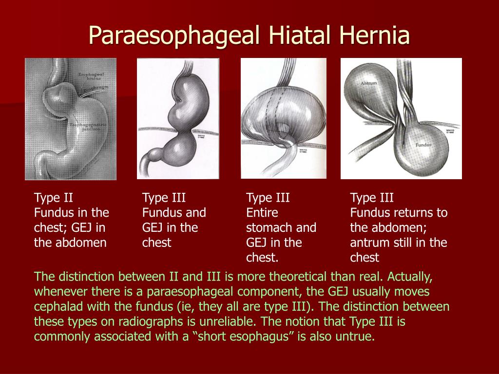 Ppt Laparoscopic Paraesophageal Hiatal Hernia Repair And | Sexiz Pix