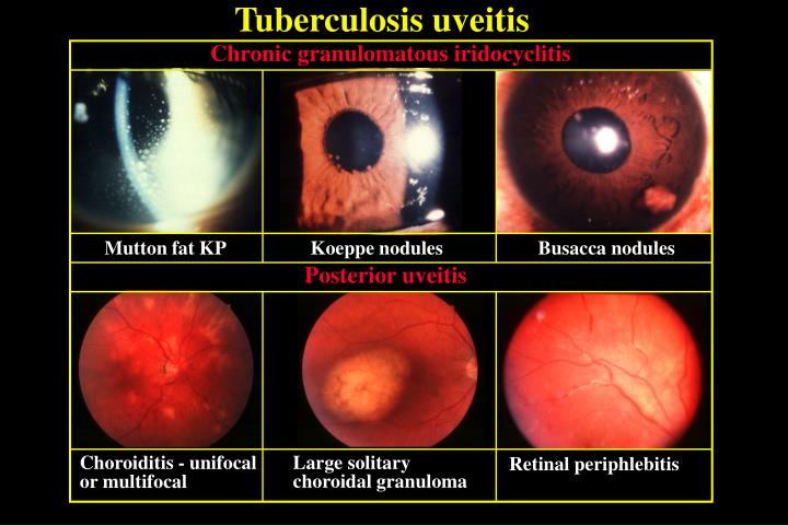 PPT - UVEAL INFECTIONS AND INFESTATIONS PowerPoint Presentation - ID ...