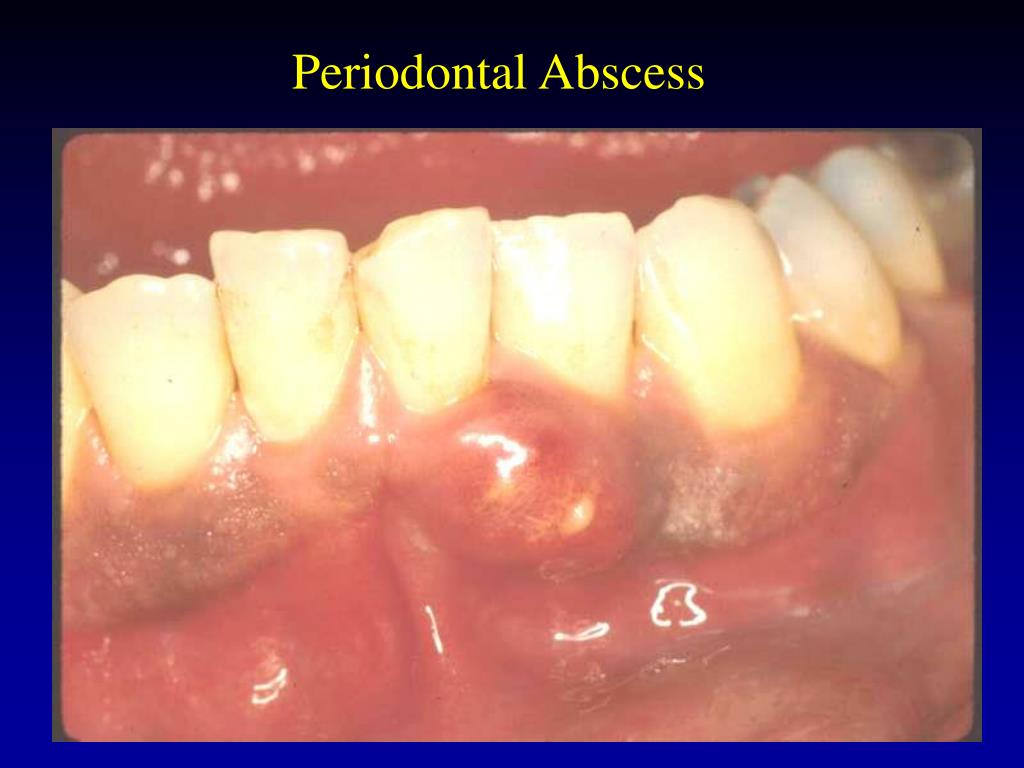 PPT ACUTE PERIODONTAL CONDITIONS PowerPoint Presentation Free 