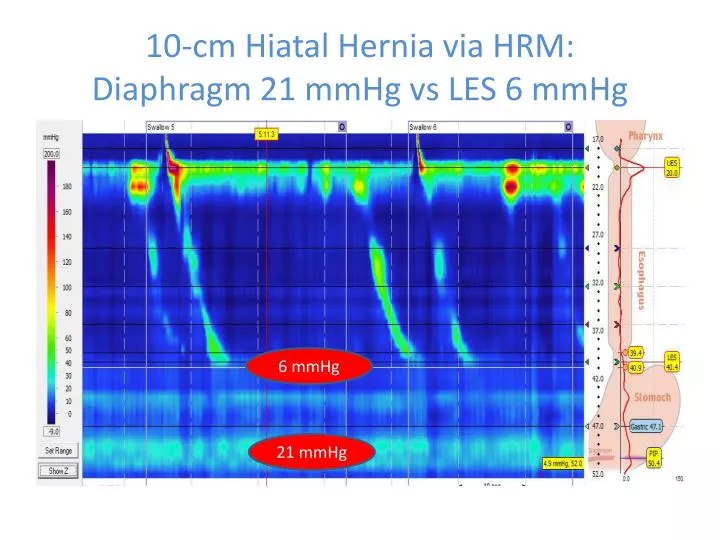 hernia hiatal 3 cm