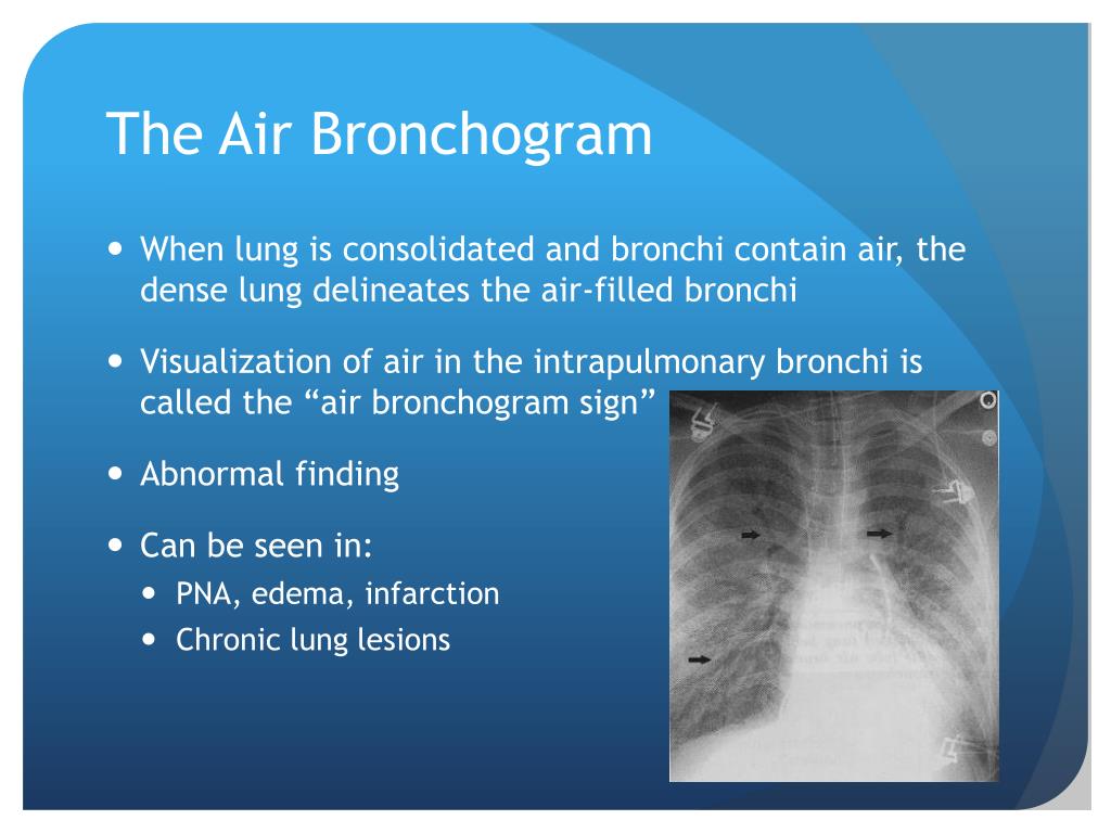 PPT Chest X Ray Interpretation For The Internist PowerPoint 