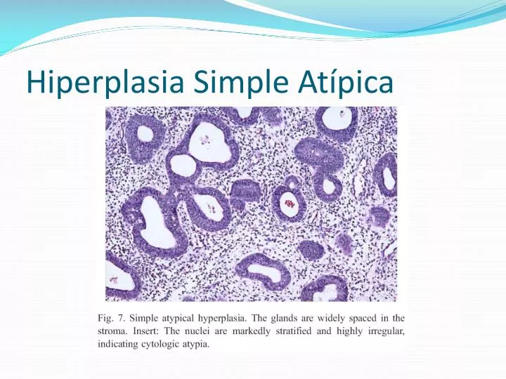 hiperplasia simple at pica n.