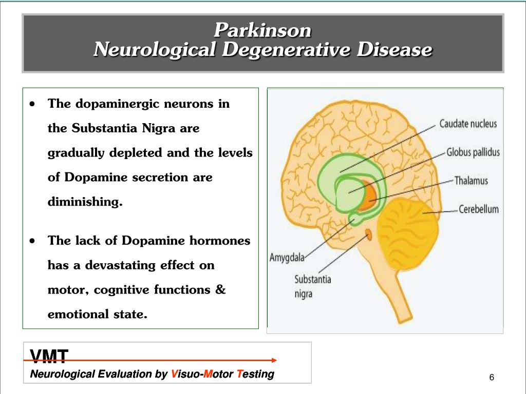 misdiagnosis of parkinsons