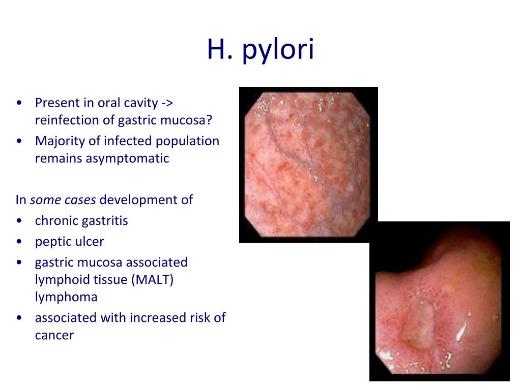 gyomorrák h pylori-ból