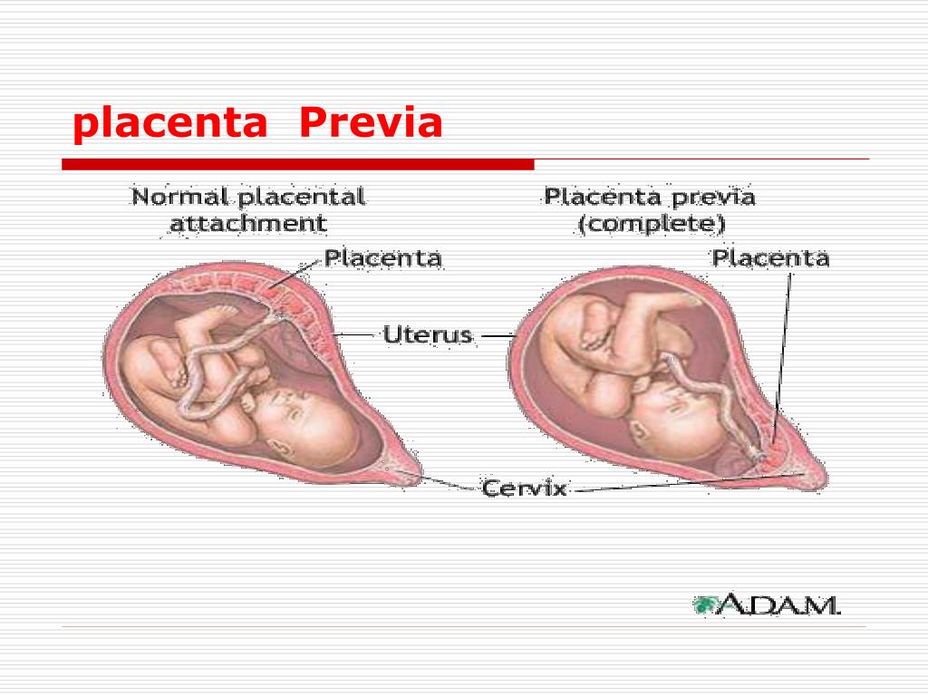 difference between vasa previa placenta previa
