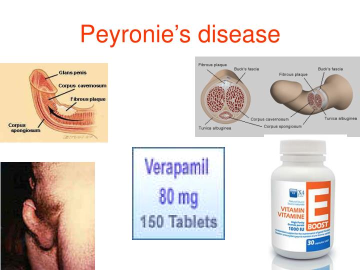 Peyronie Disease Images 