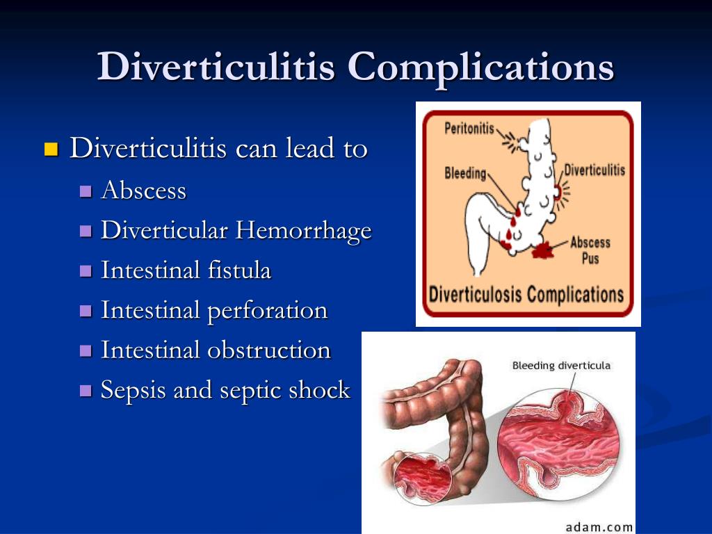 Diverticulitis can lead to * Abscess * Diverticular Hemorrhage * Intestinal...