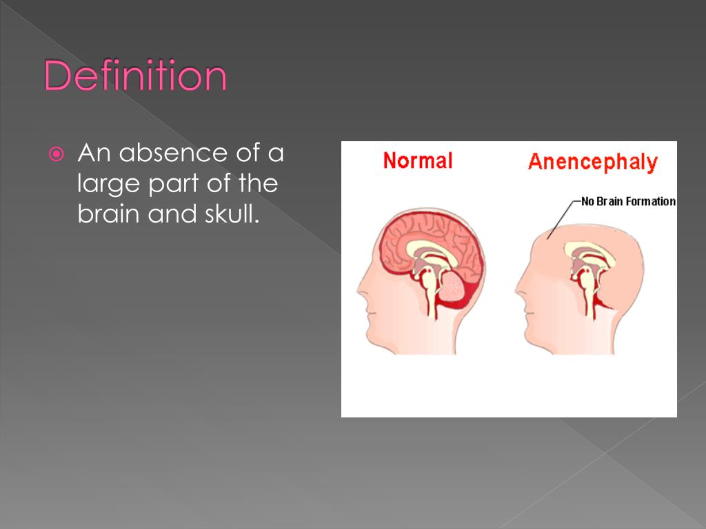 anencephaly diagram