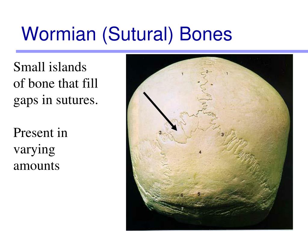 What Is Wormian Bones