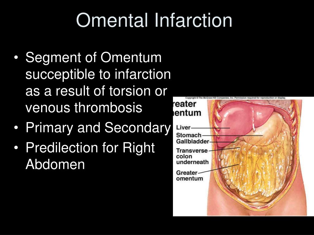 PPT Omental Infarction and Epiploic Appendagitis PowerPoint