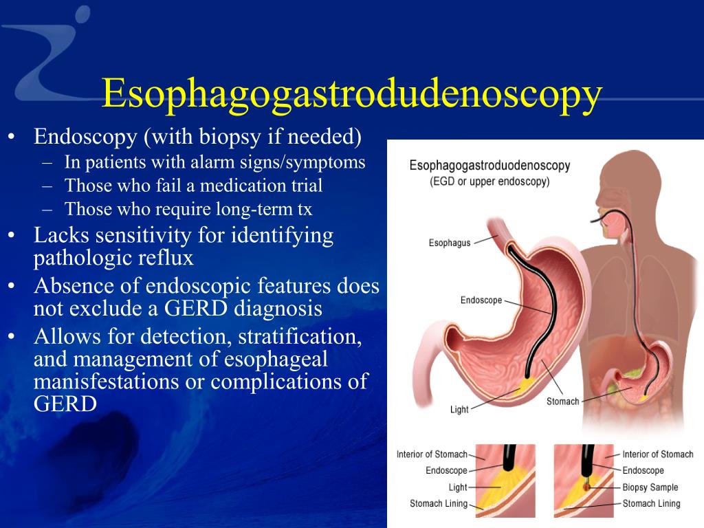 PPT gastroesophageal reflux disease GERD PowerPoint Presentation