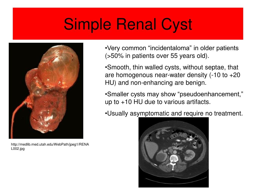 adrenal cyst on kidney