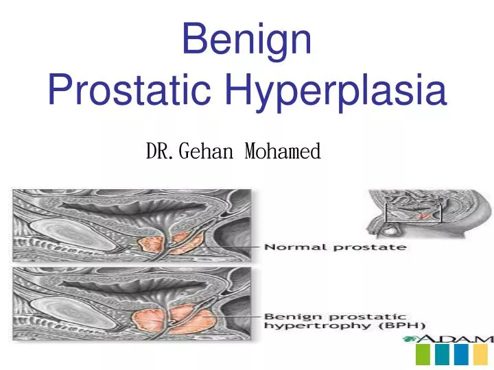 benign prostatic hyperplasia n.