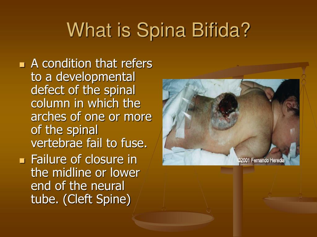 what kind of disorder is spina bifida