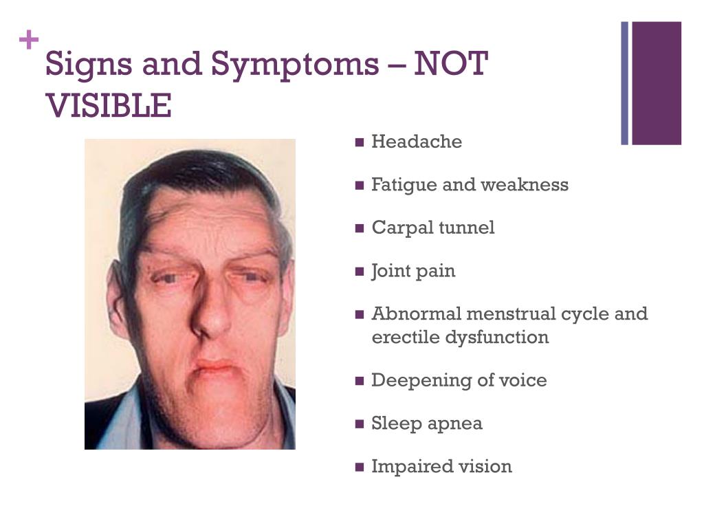 PPT - Acromegaly PowerPoint Presentation, free download - ID:6875837