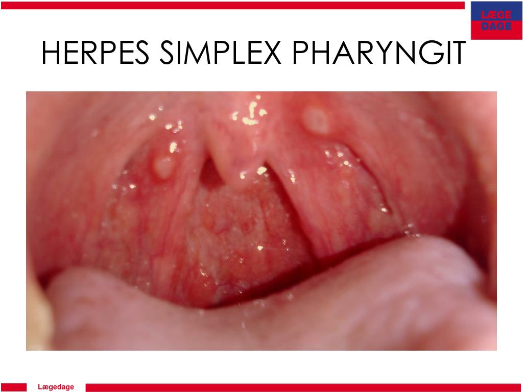 herpes simplex pharyngit.