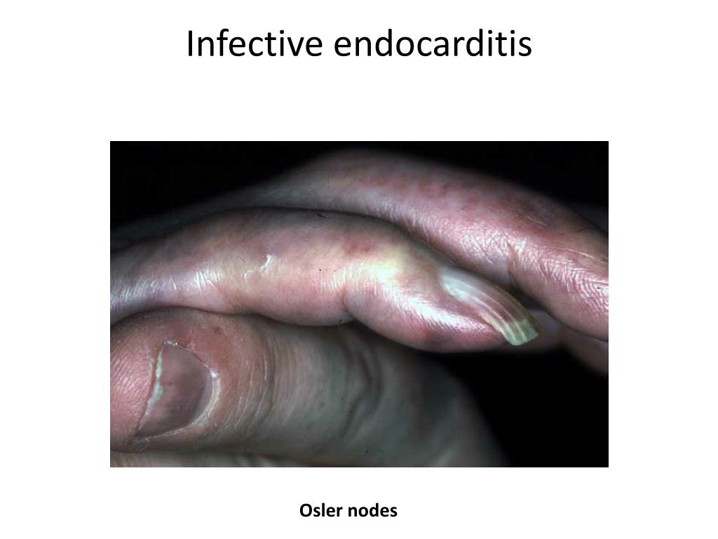 PPT - Cutaneous Manifestation of Cardiovascular Disease PowerPoint ...