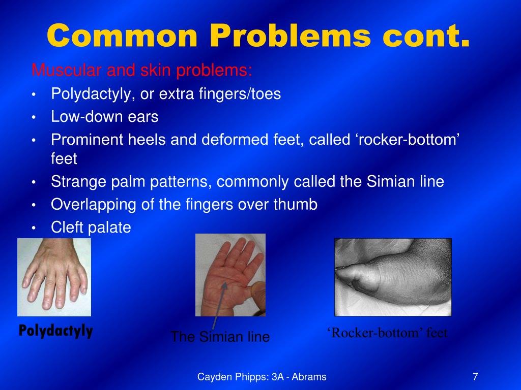 PPT - Patau Syndrome PowerPoint Presentation, free download - ID:6905046