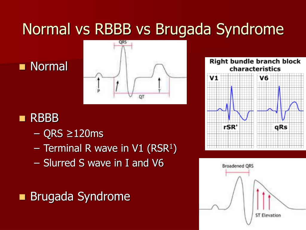 PPT Brugada Syndrome PowerPoint Presentation, free download ID6925466