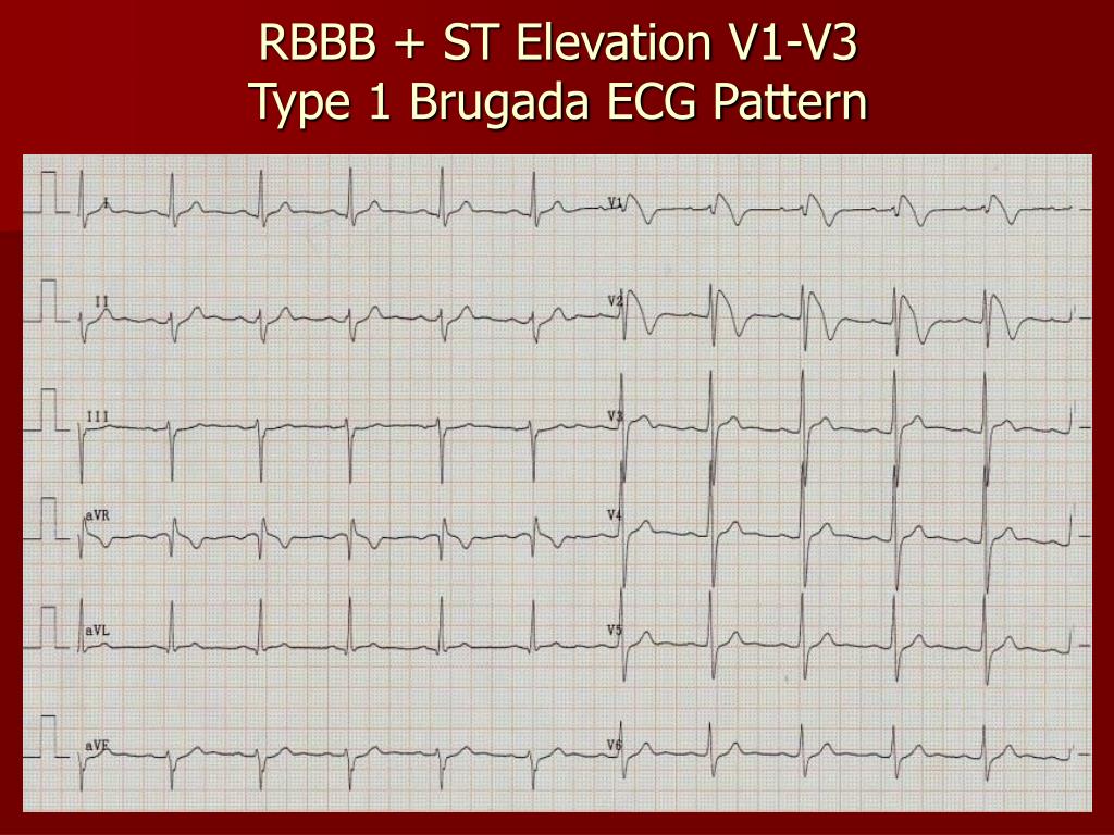 PPT Brugada Syndrome PowerPoint Presentation, free download ID6925466
