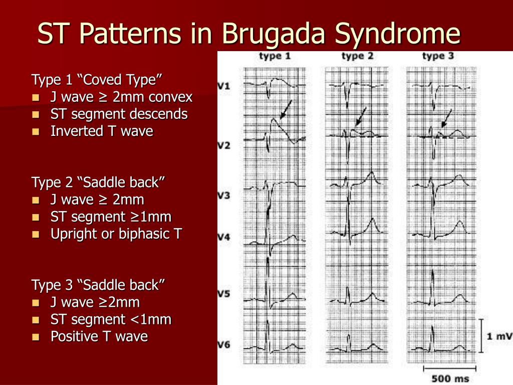 PPT - Brugada Syndrome PowerPoint Presentation, free download - ID ...