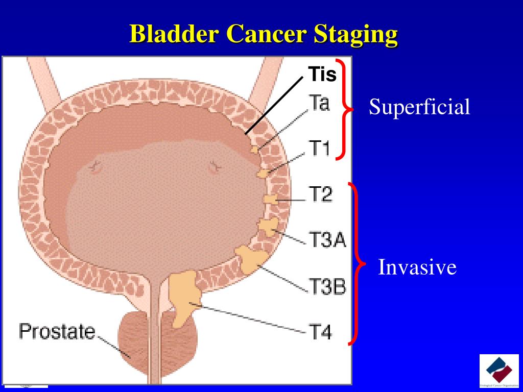 Опухоль мочевого пузыря. Классификация опухоли мочевого пузыря TNM. Опухоли мочевого пузыря морфология. Stages of cancer