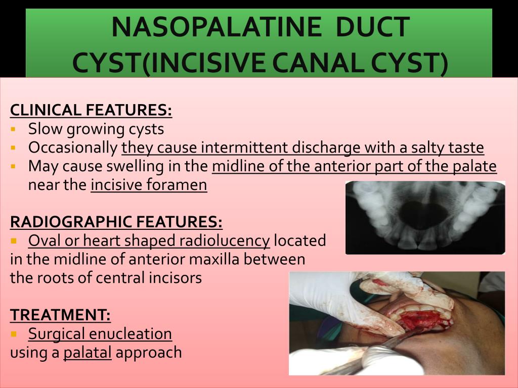 Palatine Nasal Duct Cyst