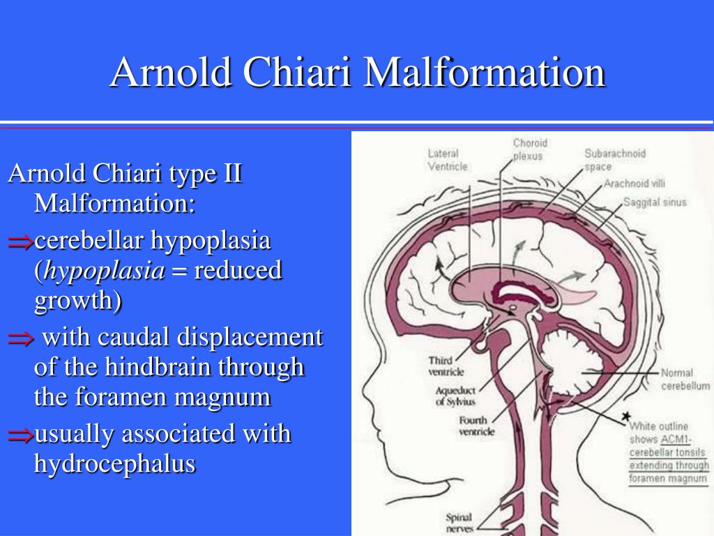 PPT - Neural Tube Defects PowerPoint Presentation, free download ...