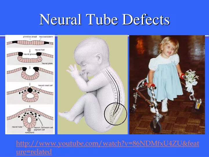 neural tube defects n.