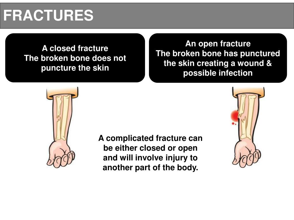 A closed fracture The broken bone does not puncture the skin An open fractu...