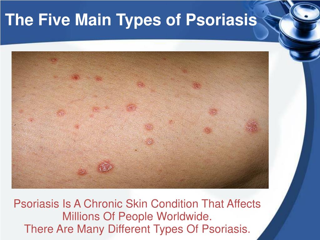 Ppt The Five Main Types Of Psoriasis Powerpoint Presentation Free