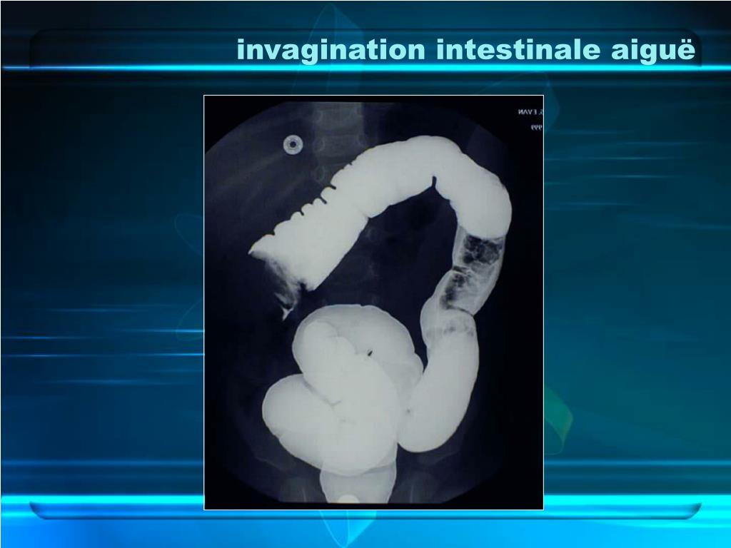 invagination-intestinale-traitement-kuyb
