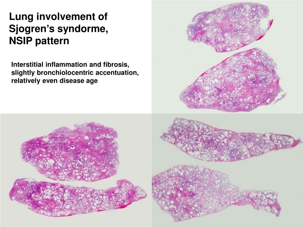 PPT - A 44-yr-old man with dyspnea (ATS Gr II) PowerPoint Presentation ...
