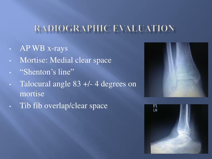 PPT - Ankle Fractures: syndesmosis PowerPoint Presentation - ID:6959736