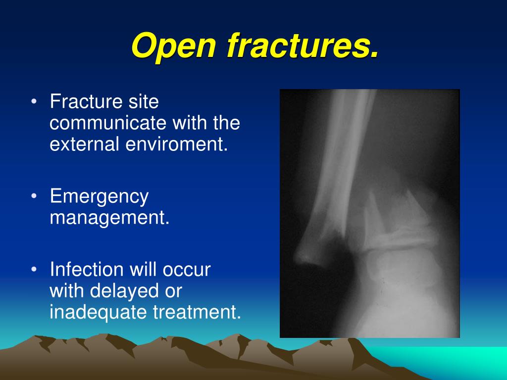 Ppt Principles Of Fractures2 Powerpoint Presentation Free Download