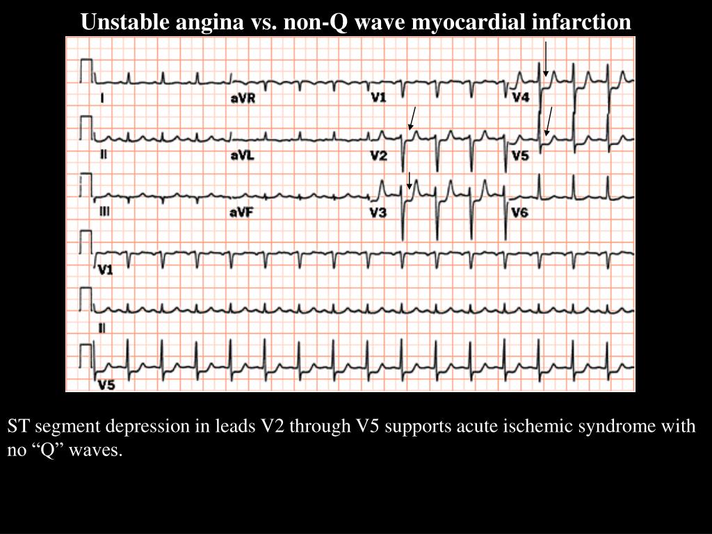 PPT - Electrocardiography PowerPoint Presentation, free download - ID ...