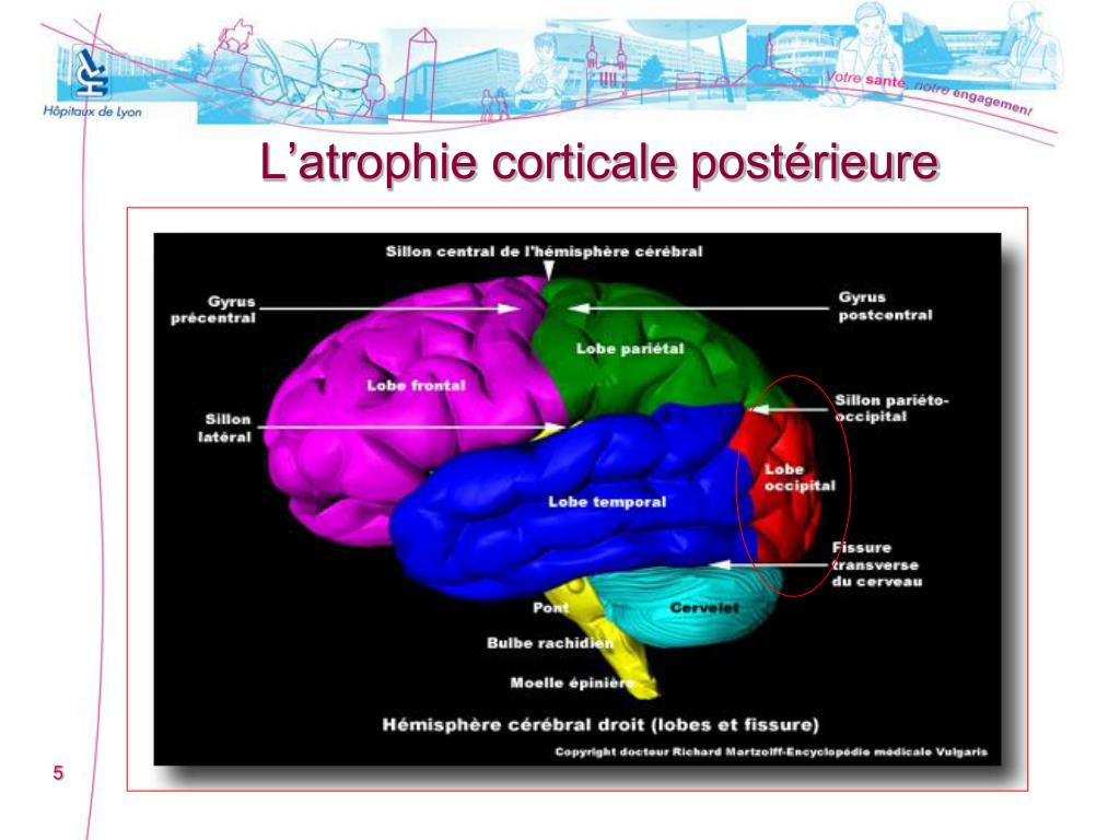PPT L’atrophie corticale postérieure. Prise en soin à l’hôpital de — free download