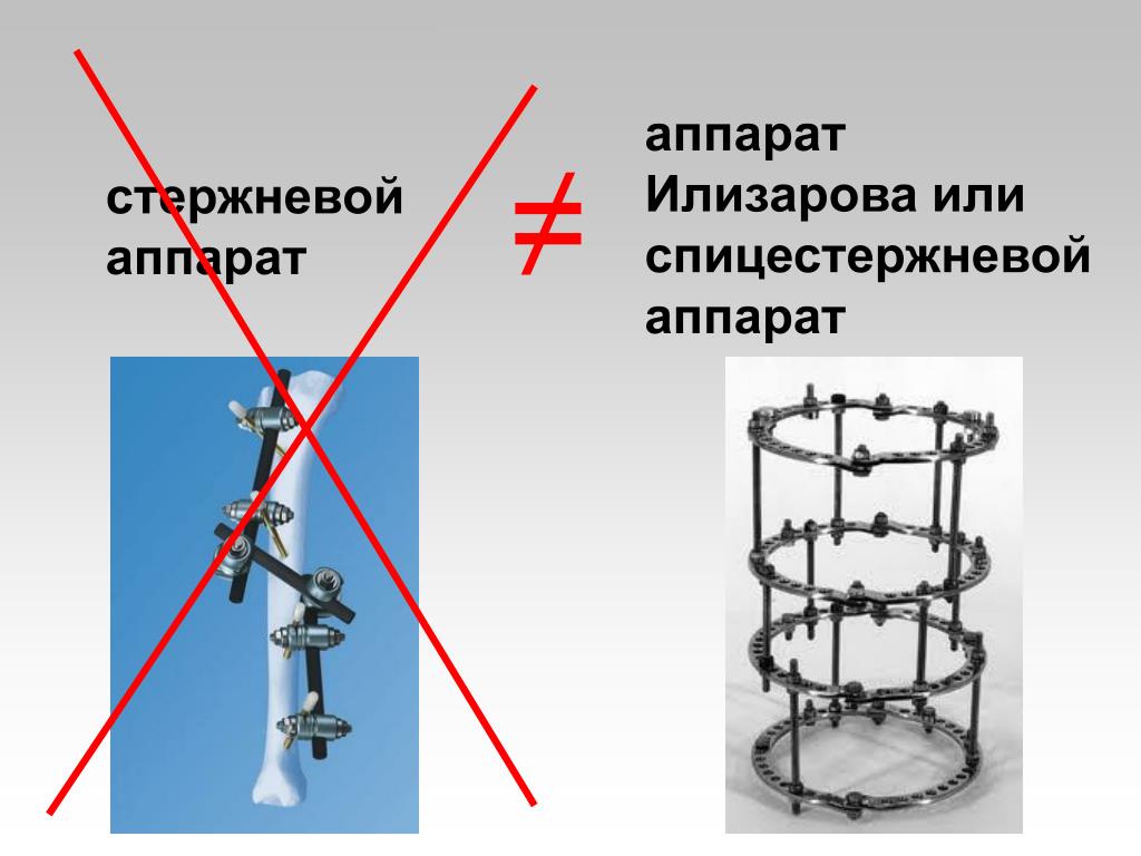 Илизаров аппарат купить. Компрессионно-дистракционный аппарат Илизарова. Стержневой аппарат Илизарова.