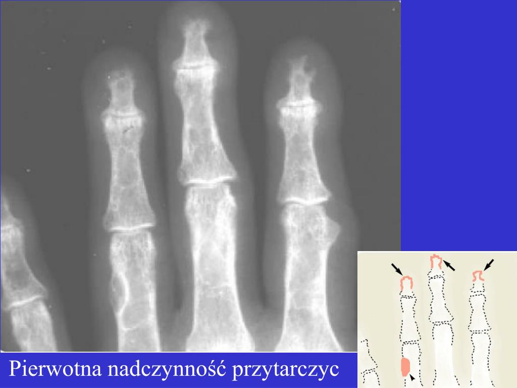 Pierwotna nadczynność przytarczyc