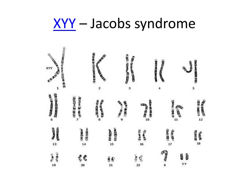 47 Xyy Jacobs Syndrome 