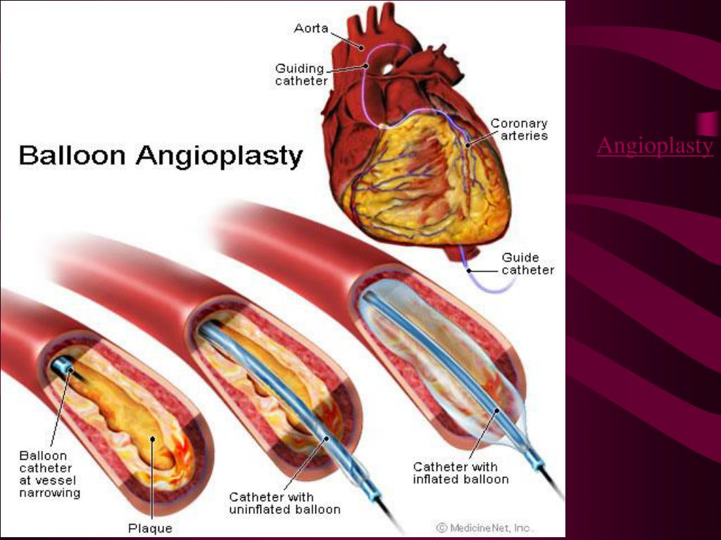 Операция ангиопластика. Стентирование коронарных артерий схема. Операция стентирования коронарных сосудов сердца. Лазерная ангиопластика коронарных артерий. ТРАНСЛЮМИНАЛЬНАЯ ангиопластика коронарных артерий.