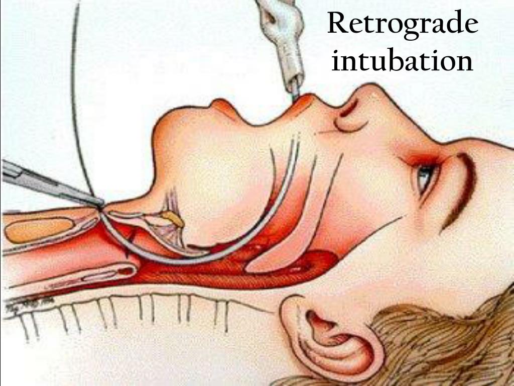 PPT Anesthetic management of maxillofacial surgery PowerPoint