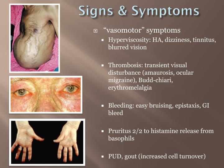 PPT - Polycythemia vera PowerPoint Presentation - ID:7007827