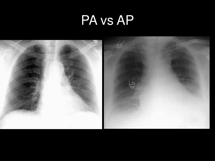 PPT - Chest X-ray PowerPoint Presentation - ID:7036416