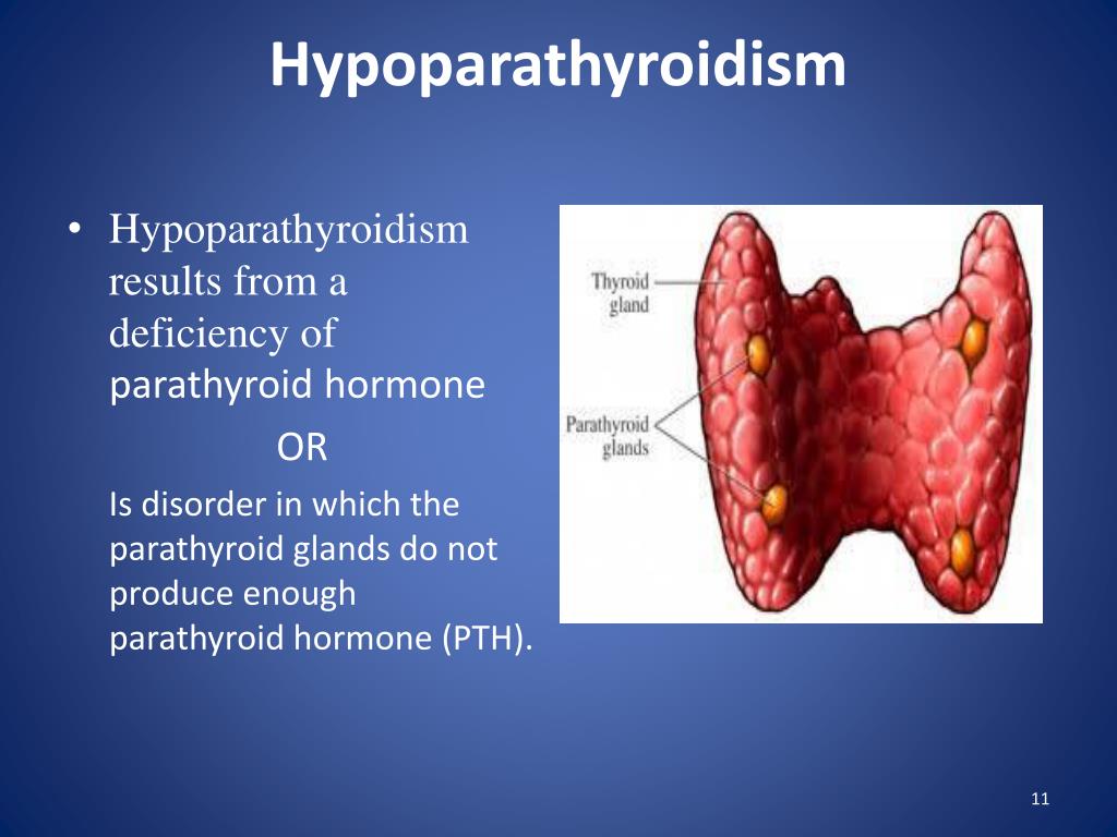 Hipoparatiroidisme Hypoparathyroidism Punca Simptom Diagnosis Sexiz Pix