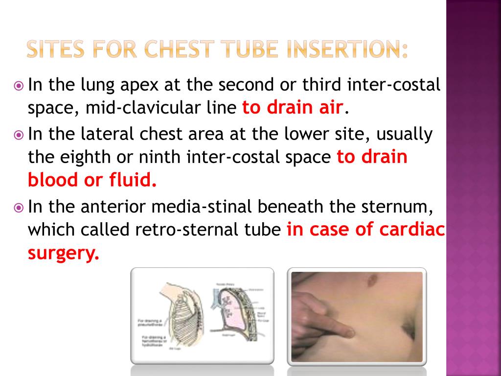 PPT - Chest Tube PowerPoint Presentation, free download - ID:7066708