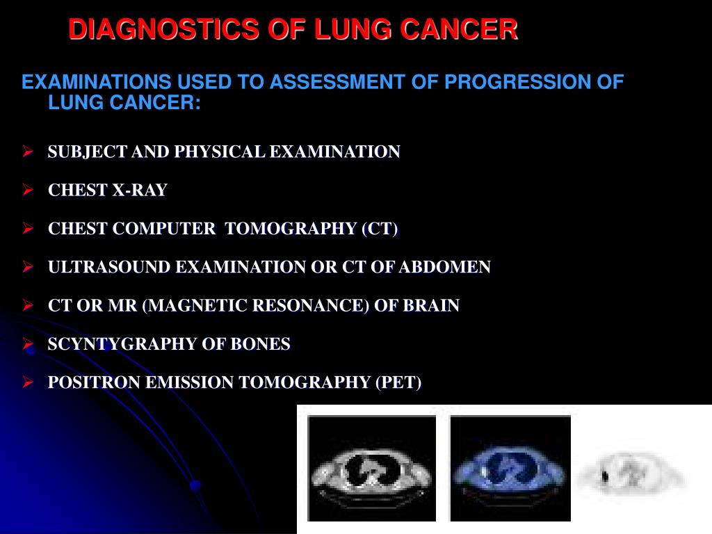 PPT - MODERN DIAGNOSIS AND TREATMENT OF LUNG CANCER PowerPoint ...