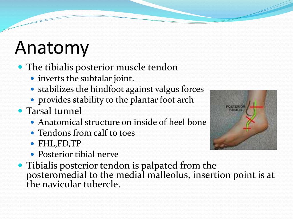 PPT - Tibialis posterior tendinopathy PowerPoint ...