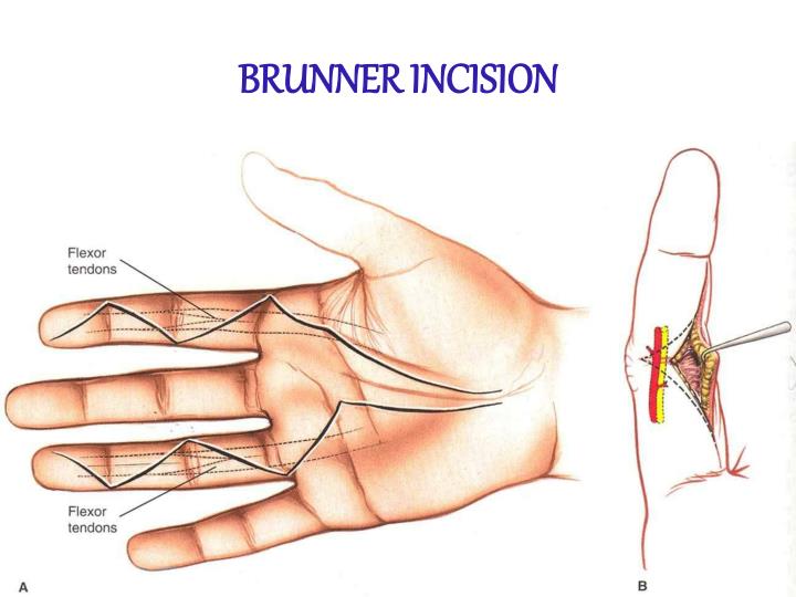 Brunner Incision Han PPT - Cut Wrist & Flexor tendon injury PowerPoint Presentation - ID:7081690